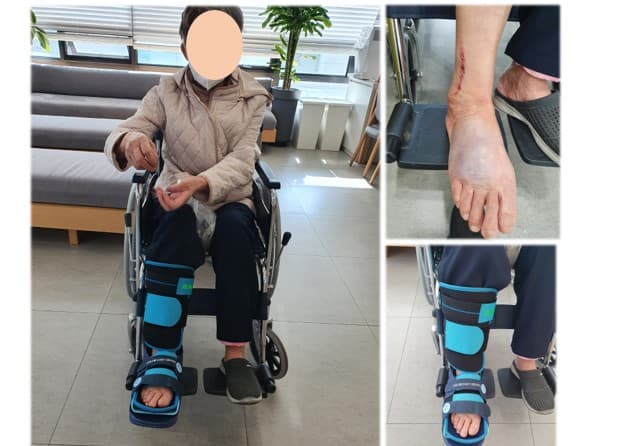 000어르신 발가락 골절